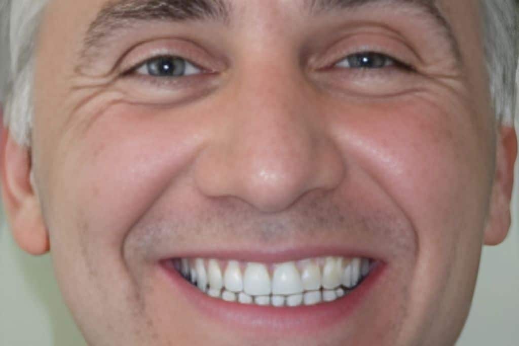 <span class="bt_bb_before_after_image_after_text">After</span>