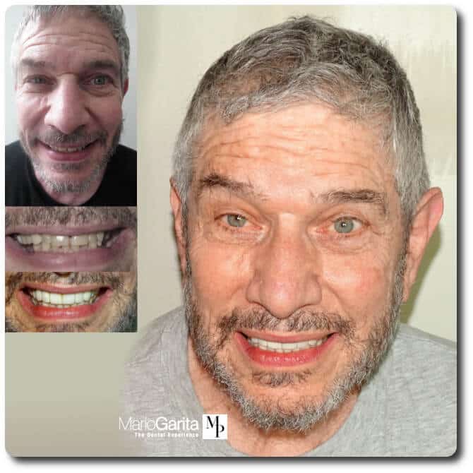 Roy Gordon Before and After dental implants https://www.dentalimplantscr.com/wp-content/uploads/2016/08/Roy-Gordon-Before-and-After-dental-implants.jpg