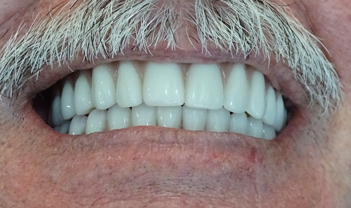 <span class="bt_bb_before_after_image_after_text">After</span>