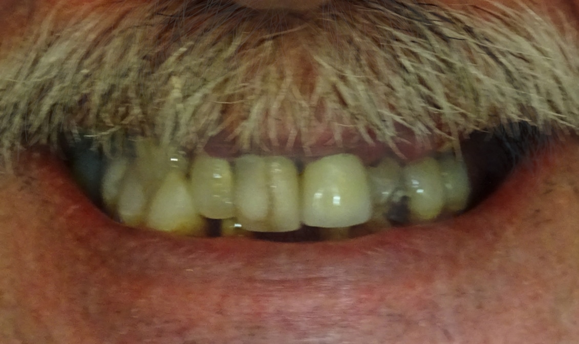 <span class="bt_bb_before_after_image_before_text">Before</span>