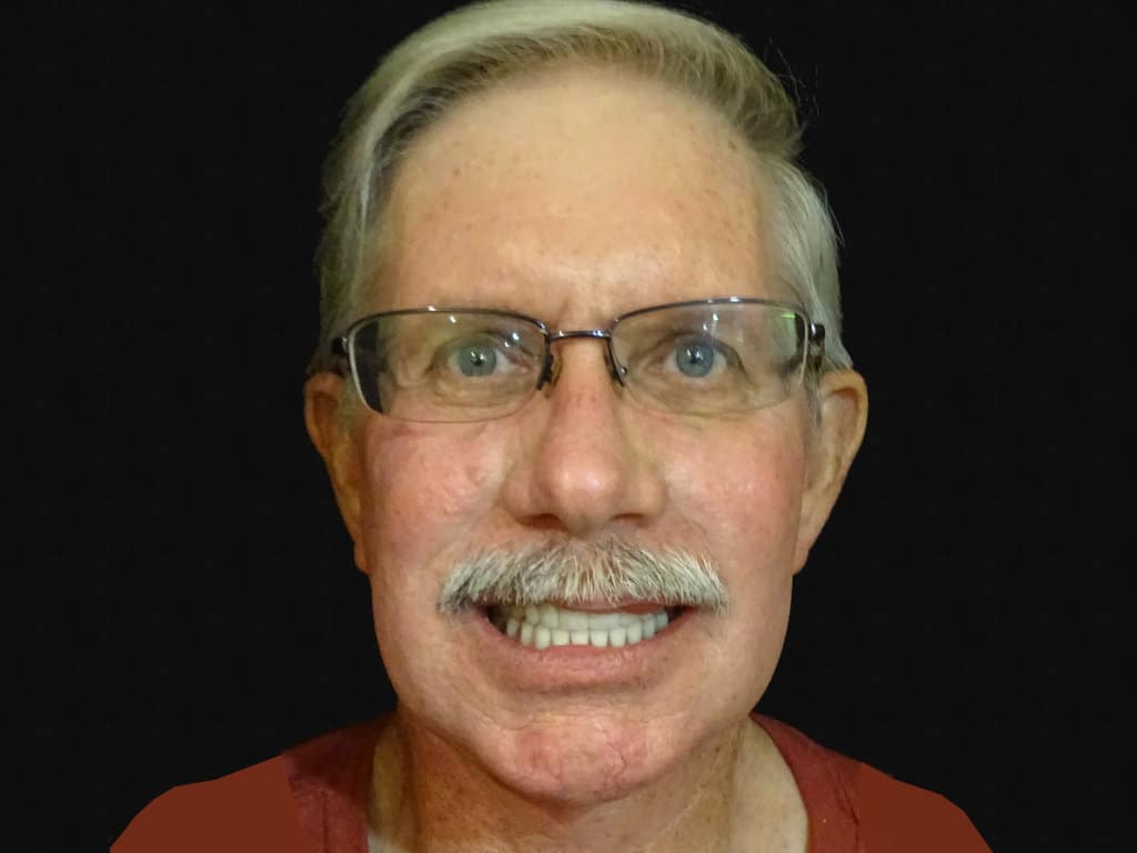 Terry-nivens-after-dental-implants https://www.dentalimplantscr.com/wp-content/uploads/2016/11/Terry-nivens-after-dental-implants.jpg