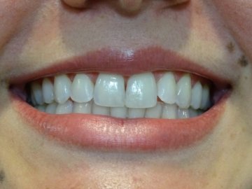 https://www.dentalimplantscr.com/wp-content/uploads/2023/12/01-front-teeth-example.jpg