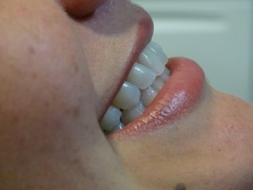 https://www.dentalimplantscr.com/wp-content/uploads/2023/12/02-right-side-teeth-example.jpg