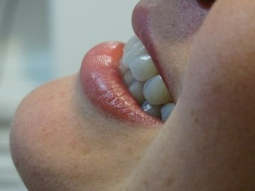 https://www.dentalimplantscr.com/wp-content/uploads/2023/12/03-left-side-teeth-example.jpg