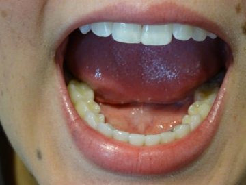 https://www.dentalimplantscr.com/wp-content/uploads/2023/12/04-open-lower-teeth-example.jpg