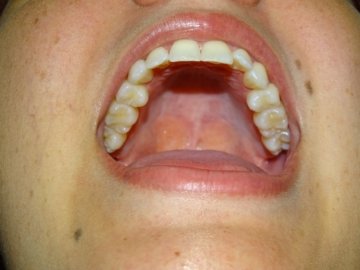 https://www.dentalimplantscr.com/wp-content/uploads/2023/12/05-open-upper-teeth-example.jpg
