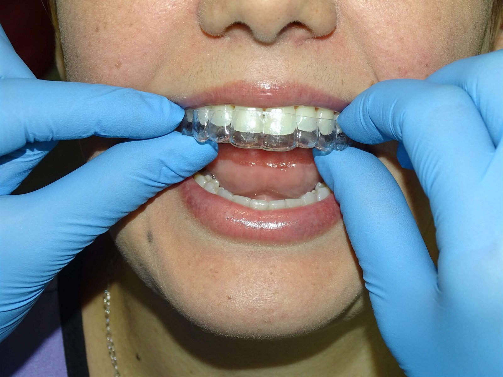 https://www.dentalimplantscr.com/wp-content/uploads/2023/12/Clear_aligners.jpg