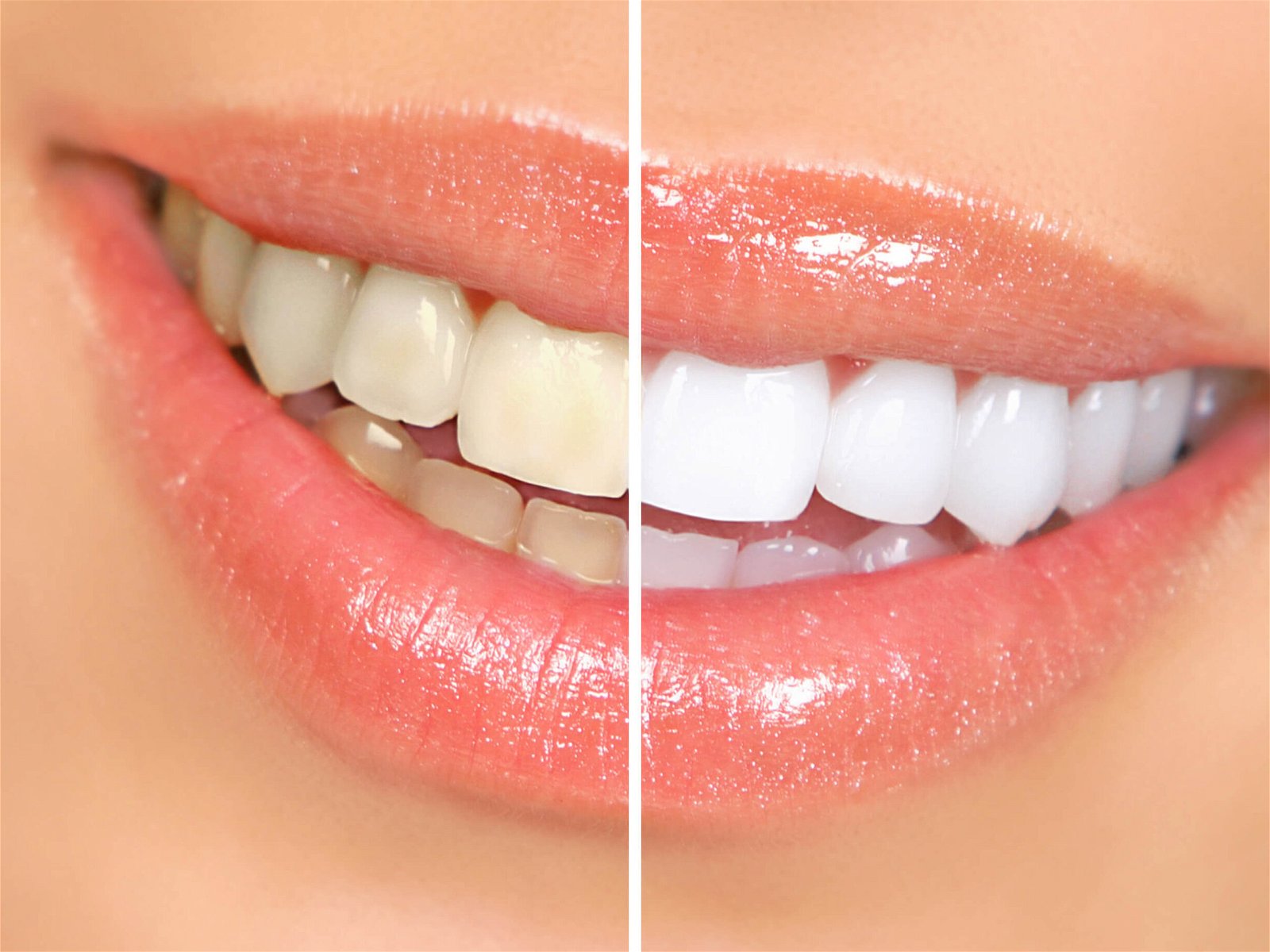 https://www.dentalimplantscr.com/wp-content/uploads/2023/12/Costa_Rica-Laser_Teeth_Whitening.jpg
