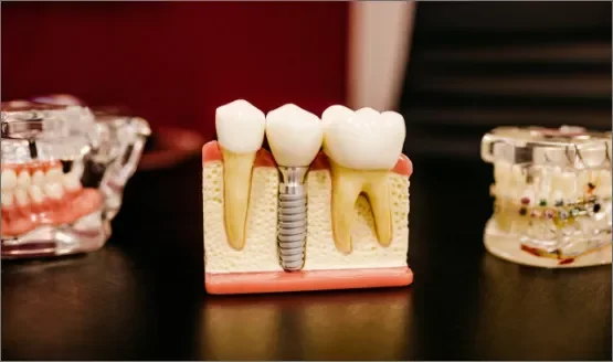 https://www.dentalimplantscr.com/wp-content/uploads/2024/02/dental-implant-shape.webp