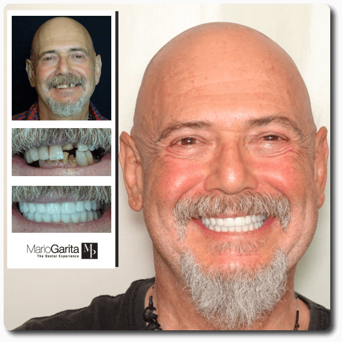 https://www.dentalimplantscr.com/wp-content/uploads/2024/03/19-Scharmann-AllOn4.png