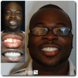 https://www.dentalimplantscr.com/wp-content/uploads/2024/04/05-Glenn-Wesby-crowns-160x160.png